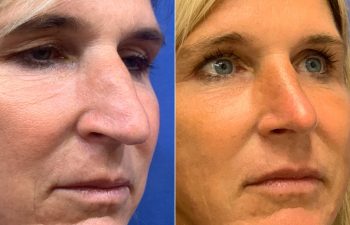 Eden Plastic Surgery Institute female patient before and after rhinoplasty.