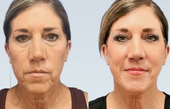 Eden Plastic Surgery Institute female patient before and after Eve lift procedure.