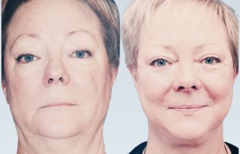 Eden Plastic Surgery Institute female patient before and after Eve lift procedure.