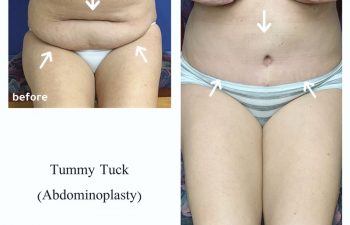 Eden Plastic Surgery Institute female patient before and after abdominoplasty surgery.