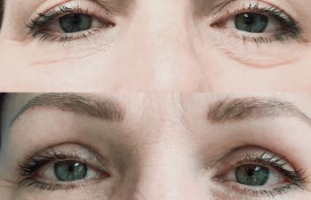 Eden Plastic Surgery Institute female patient before and after Eye Glow procedure.