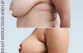Eden Plastic Surgery Institute female patient before and after breast reduction and lift.