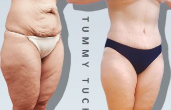 Eden Plastic Surgery Institute female patient before and after tummy tuck surgery.