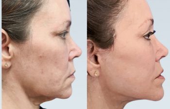 Eden Plastic Surgery Institute female patient's face before and after Eve lift procedure.