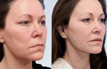 Eden Plastic Surgery Institute female patient's face before and after Eve lift procedure.