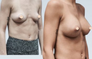 Eden Plastic Surgery Institute female patient's face before and after quick recovery breast augmentation.