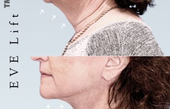 Eden Plastic Surgery Institute female patient's neck before and after Eve lift procedure.
