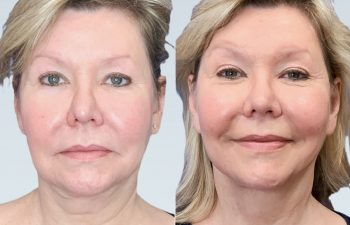 Eden Plastic Surgery Institute female patient's face before and after Eve lift procedure.