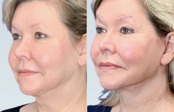 Eden Plastic Surgery Institute female patient's face before and after Eve lift procedure.