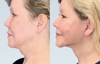 Eden Plastic Surgery Institute female patient's face before and after Eve lift procedure.