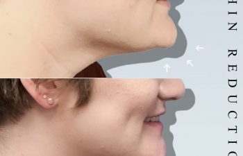 Eden Plastic Surgery Institute patient before and after chin reduction.