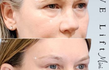 Eden Plastic Surgery Institute female patient's upper face before and after Eve lift procedure.