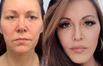 Eden Plastic Surgery Institute female patient's face before and after Eve lift procedure.