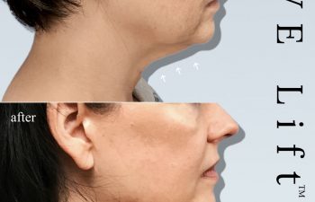 Eden Plastic Surgery Institute female patient's chin and neck before and after Eve lift procedure.