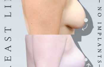Eden Plastic Surgery Institute female patient's face before and after no implants breast lift.