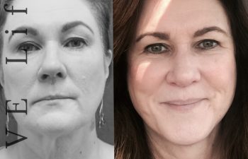 Eden Plastic Surgery Institute female patient's face before and after Eve lift procedure.