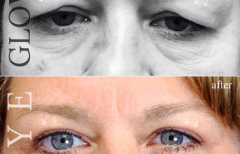 Eden Plastic Surgery Institute female patient's upper face before and after Eve lift procedure.