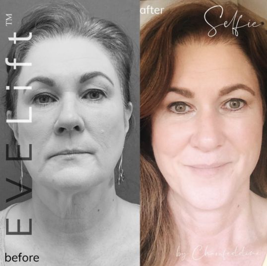 Eden Plastic Surgery Institute female patient before and after facial cosmetic surgery.