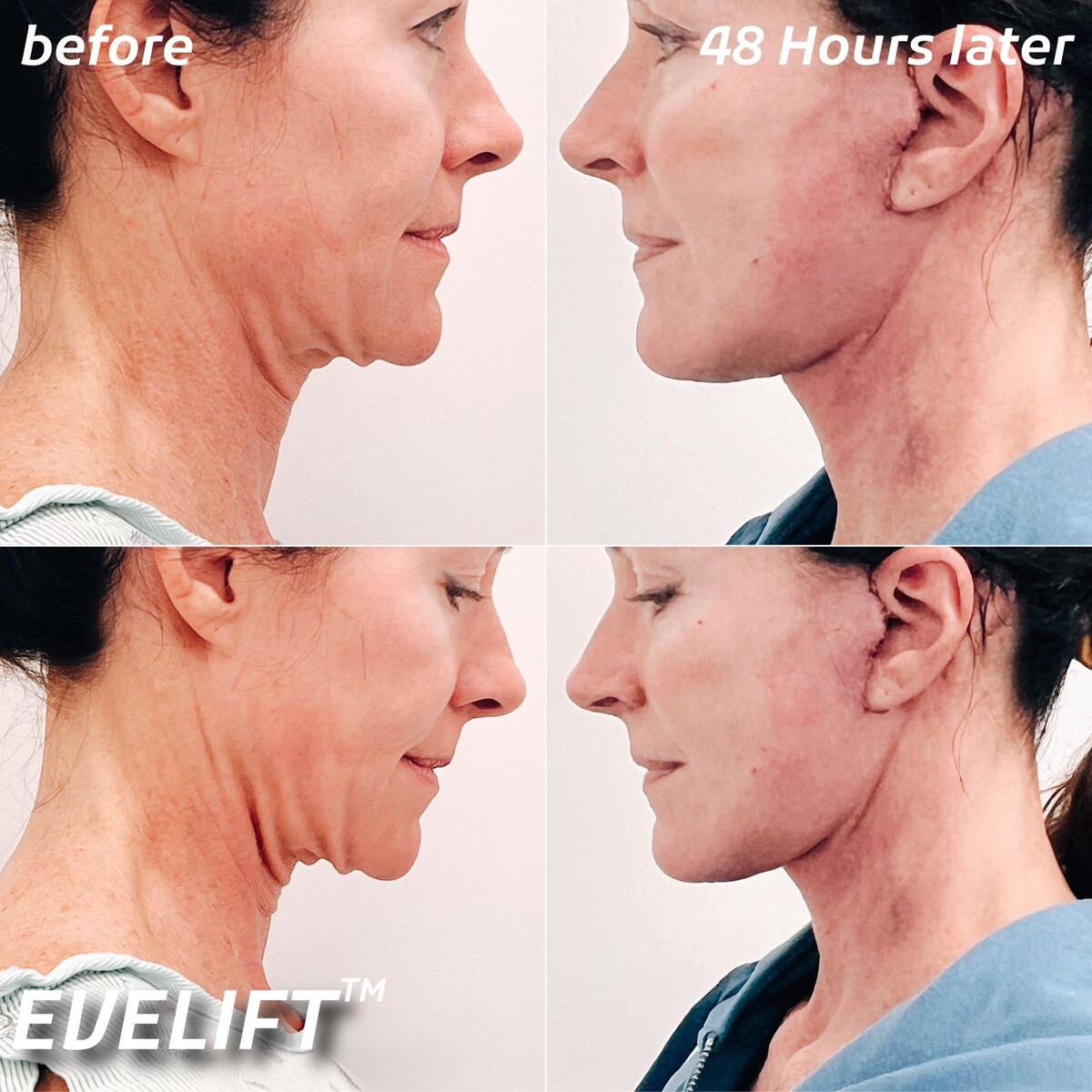 EVE Lift Before and After