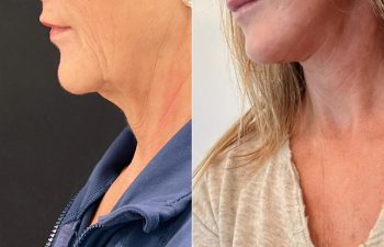 Eden Plastic Surgery Institute female patient's before and after Eve lift procedure.