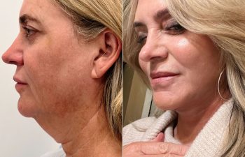 Eden Plastic Surgery Institute female patient's before and after Eve lift procedure.