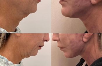 Eden Plastic Surgery Institute female patient's before and after Eve lift procedure.