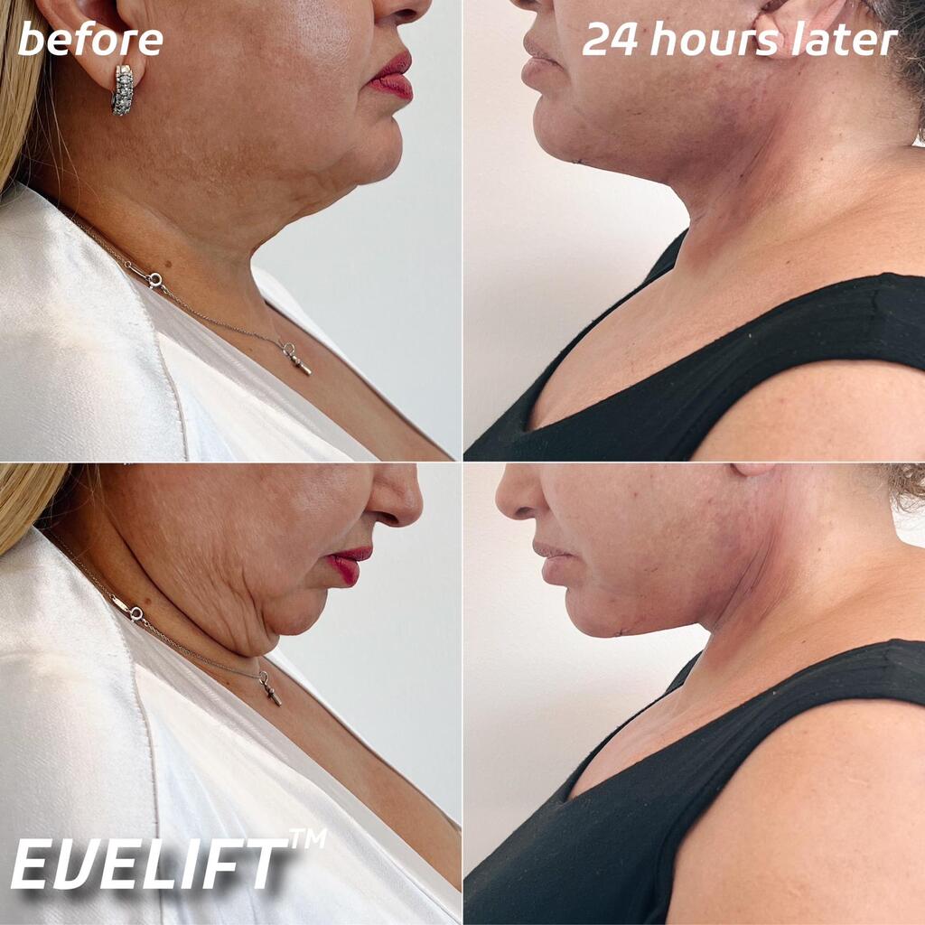 Eve Lift Before and After Comparison
