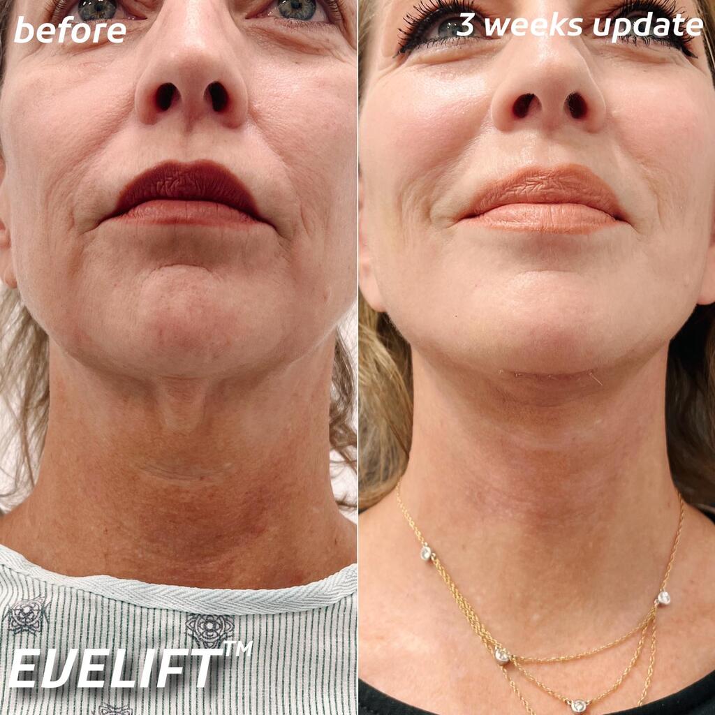 Eve Lift Before and After Comparison