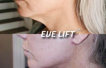 EVE Lift Before and After