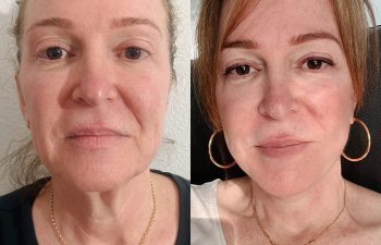 EVE Lift Before and After