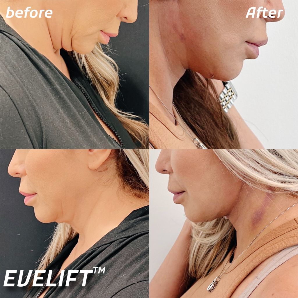 Female patient before and after Eve Lift procedure