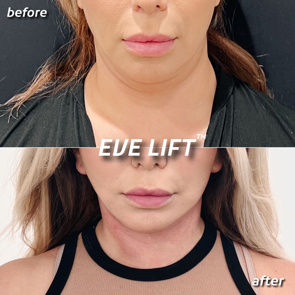 Female patient before and after Eve Lift procedure