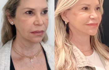 EVE Lift Before and After