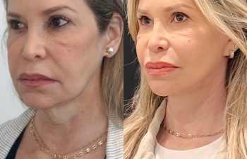 EVE Lift Before and After