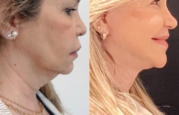 EVE Lift Before and After