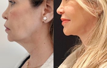 EVE Lift Before and After