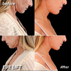 The EVELift® Facelift before and after