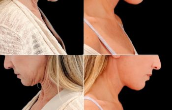 EVE Lift Before and After