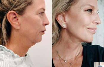 EVE Lift Before and After