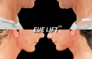 female patient before and after EVE Lift procedure