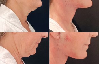 EVE Lift Before and After