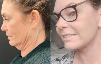 EVE Lift Before and After