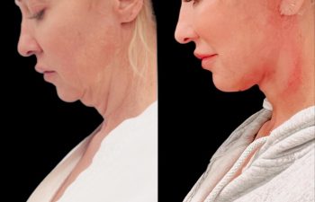 EVE Lift Before and After