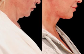 EVE Lift Before and After