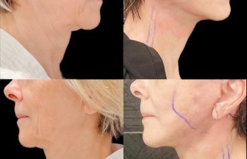 EVE Lift Before and After