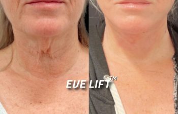 female patient before and after Eve Lift procedure
