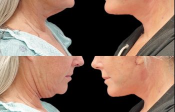 female patient before and after Eve Lift procedure