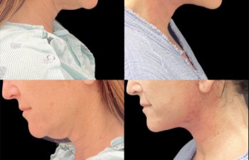 female patient before and after Eve Lift procedure