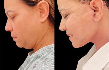 female patient before and after Eve Lift procedure