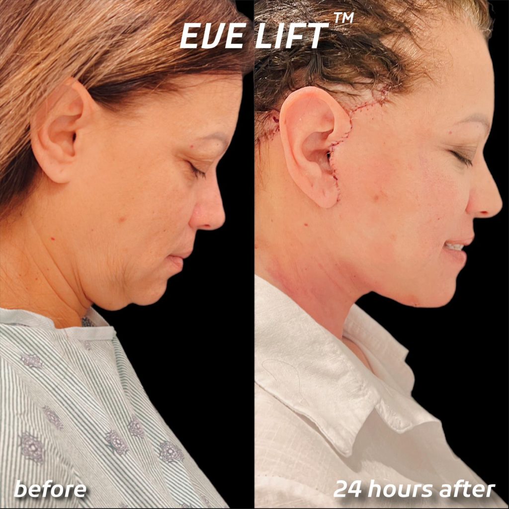 female patient before and after Eve Lift procedure